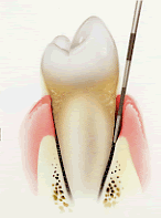 Measuring a periodontal pocket depth