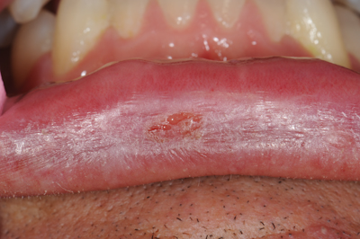 Herpes on sale inside mouth