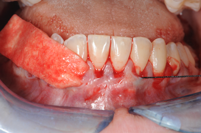 gingival graft alloderm